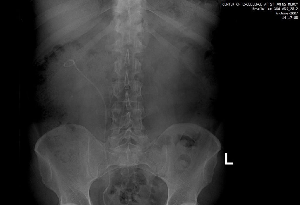X-Ray of stent from urethra to ureter and up to the right kidney. This is an image just before it was taken out.