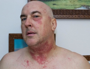 I spread poison ivy oil over my body during a shower.