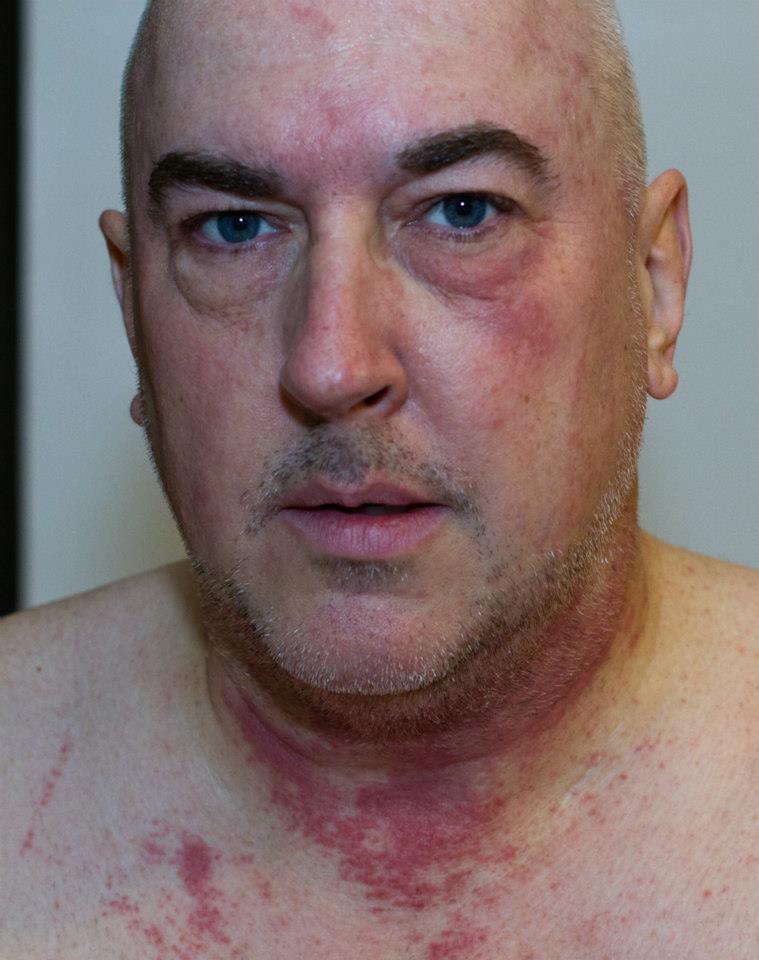 I spread poison ivy oil over my body during a shower.