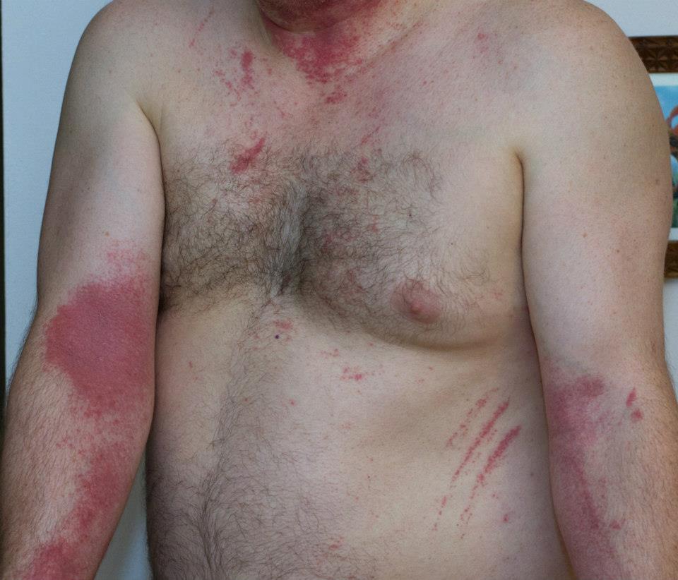 I spread poison ivy oil over my body during a shower.