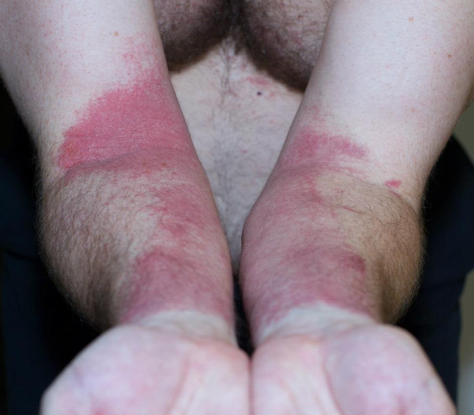I spread poison ivy oil over my body during a shower.