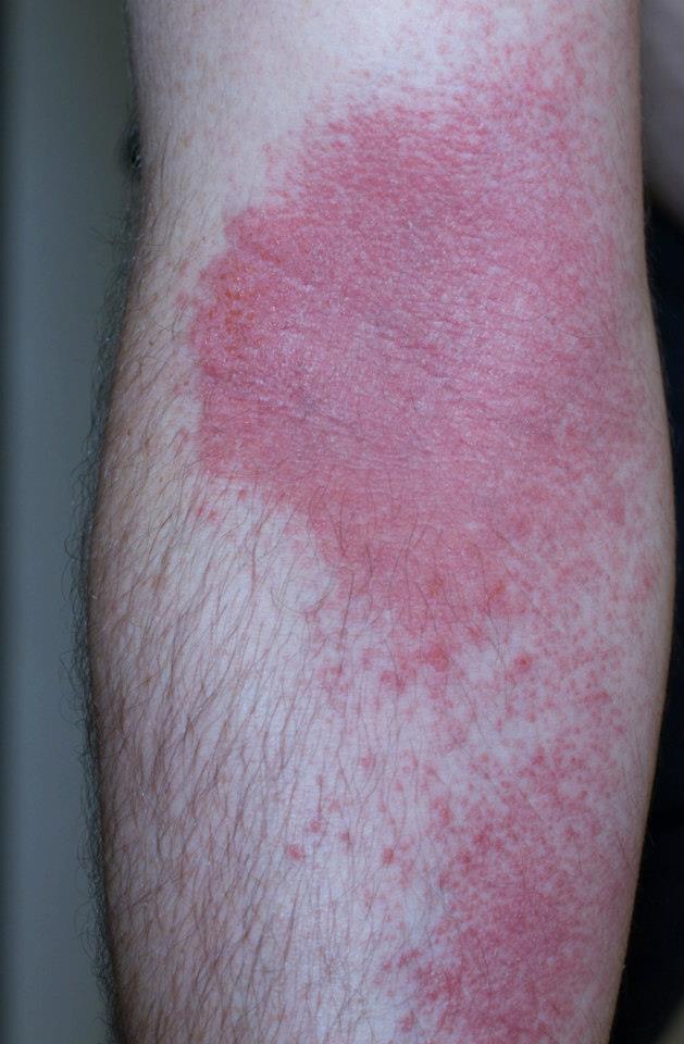 I spread poison ivy oil over my body during a shower.
