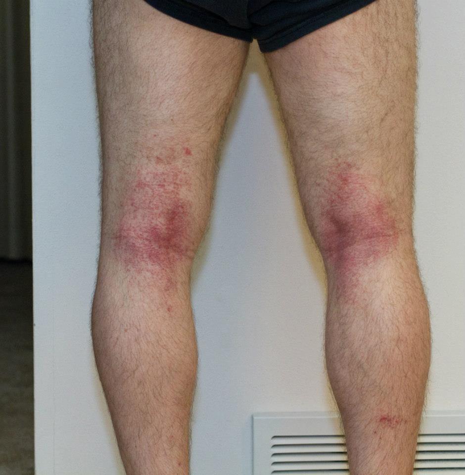 I spread poison ivy oil over my body during a shower.
