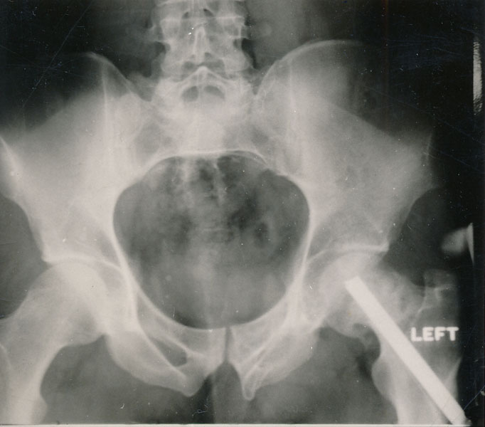 Early 1950s - Vern took a spill on motorcycle and broke his left hip. He had a permanent limp after that.